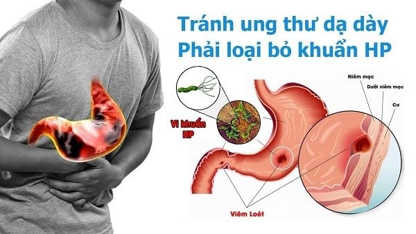 dạ dày chứa vi khuẩn HP có nguy cơ mắc bệnh ung thừ dạ dày