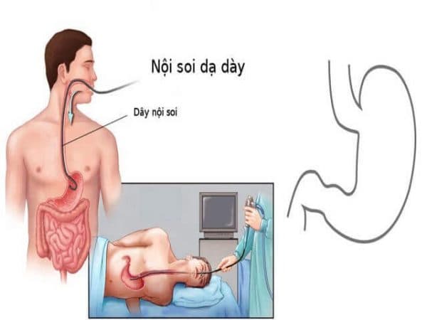 nội soi tiêu hóa cho trẻ em không đau tại Thu Cúc