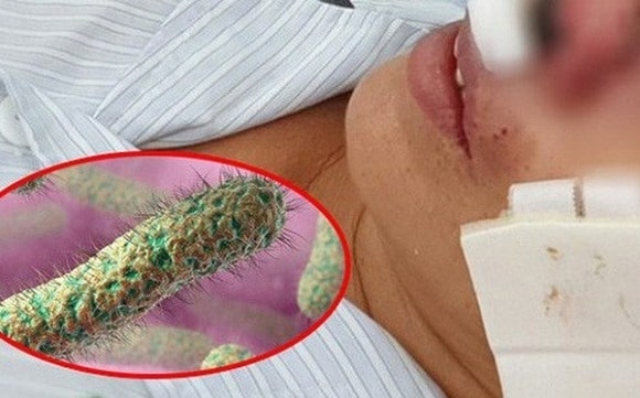 bệnh whitmore không phải vi khuẩn ăn thịt người