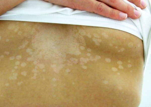 Những mảng da có màu sắc khác nhau, thường xuất hiện ở lưng, ngực, cổ hoặc vùng nách của trẻ. (ảnh minh họa)