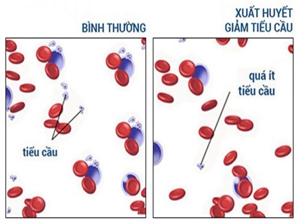 thế nào là sốt xuất huyết giảm tiểu cầu