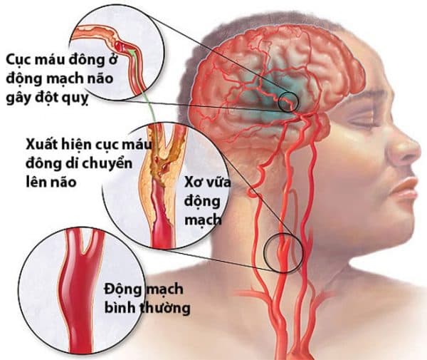 mỡ máu cao có thể gây tai biến mạch máu não