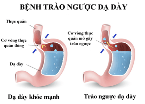 trao ngược dạ dày thực quản có nguy hiểm không