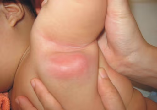 trẻ bị nổi hạch ở nách