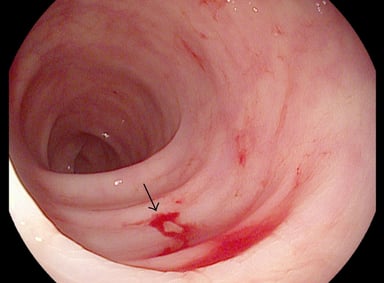 Đại tràng là gì? Vì sao phải nội soi đại tràng?