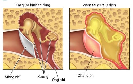 bệnh viêm tại giữa tiết dịch ở trẻ em là gì