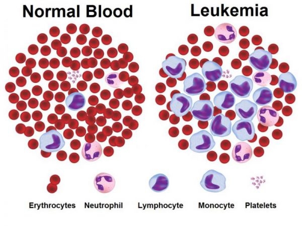 Sự nguy hiểm của bệnh Leukemia là gì và cần được điều trị như thế nào?