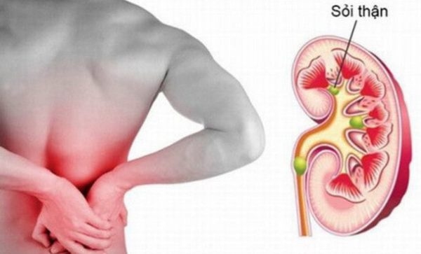 đau lưng ở nam giới do sỏi thận