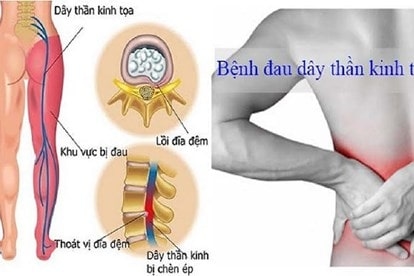 đau thắt lưng ở nam giới do đau dây thần kinh tọa