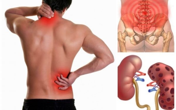 Nam giới mắc các bệnh lý về đường tiết niệu, điển hình là sỏi thận có thể gây đau mỏi thắt lưng