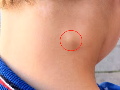 Nổi hạch ở cổ là biểu hiện của bệnh gì?