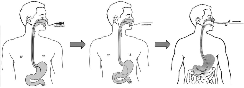 Nội soi dạ dày qua đường mũi có chính xác không?