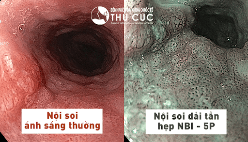nội soi dạ dày đại tràng nbi 5p