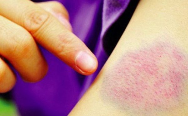 nguyên nhân gây xuất huyết giảm tiểu cầu