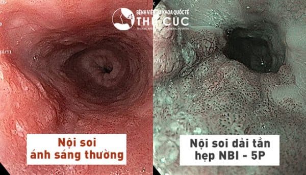 Công nghệ nội soi NBI 5P giúp đánh giá sâu dưới lớp niêm mạc dạ dày, đại tràng từ đó phát hiện các thương tổn nhỏ nhất, đồng thời phát hiện sớm các dấu hiệu ung thư đường tiêu hóa.