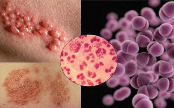 bệnh lậu là loại bệnh lây nhiễm bởi vi khuẩn Neisseria gonorrhoeae hay gonococcus dễ lây thường xuất hiện ở miệng, cơ quan sinh dục nam, nữ,...