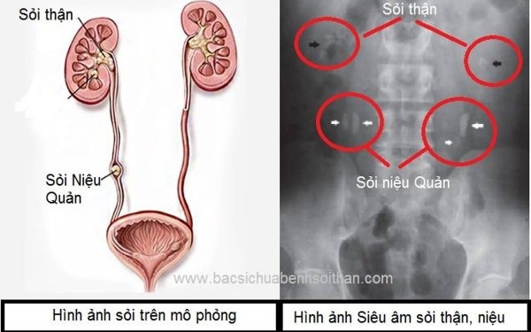 Sỏi niệu quản là gì