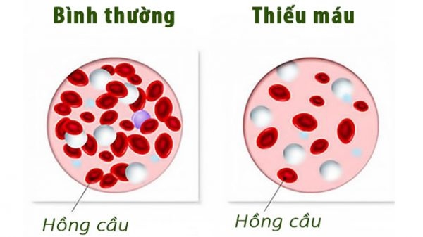 thiếu máu khiến chỉ số hồng cầu trong máu thấp