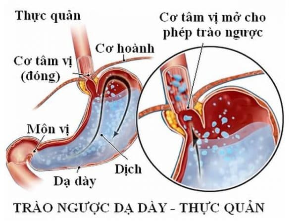 Trẻ sơ sinh bị trào ngược dạ dày thực quản sinh lý