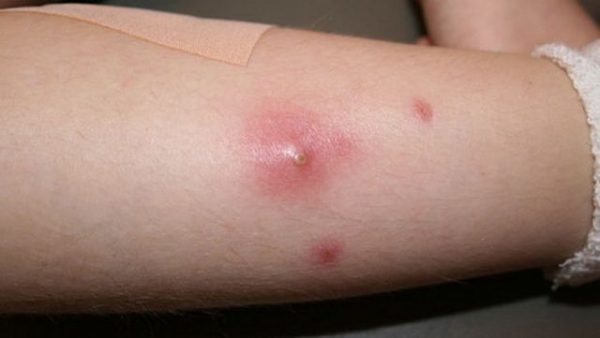 Nổi nhọt trên da là một dạng của bệnh viêm da mủ