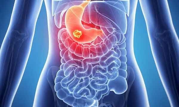 Tìm hiểu gói khám tầm soát ung thư thực quản, dạ dày, đại trực tràng nâng cao