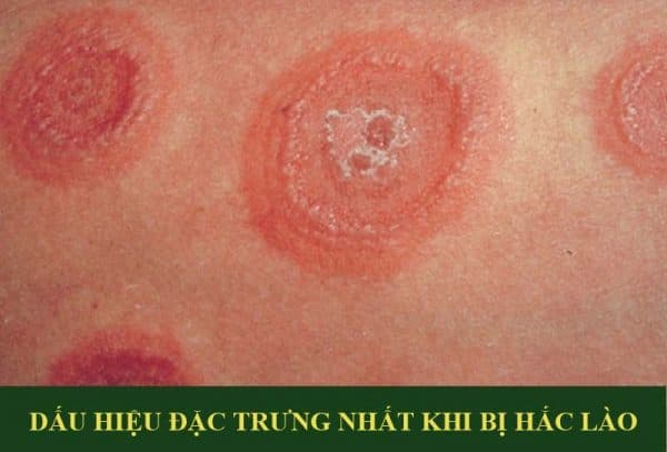 dấu hiệu bệnh hắc lào