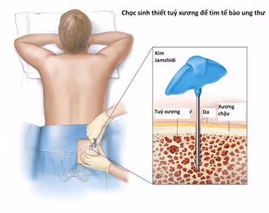 Sinh thiết là gì? Kết quả sinh thiết có chính xác không?