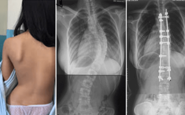 con vẹo cột sống do bị trật khớp háng bẩm sinh