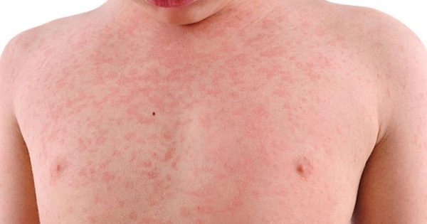Trẻ bị nổi mẩn đỏ khắp người