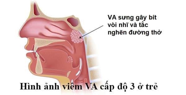 viêm VA cấp