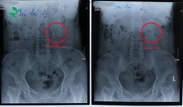 cach-dieu-tri-soi-than-to-cho-nguoi-so-dau3