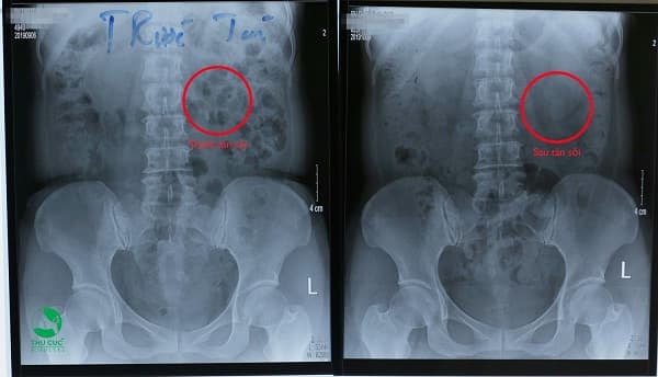 chuyen-gia-huong-dan-cach-xu-tri-khi-bi-soi-than-uong-thuoc-mai-khong-het