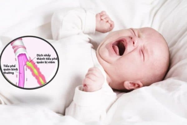 biểu hiện trẻ bị viêm tiểu phế quản