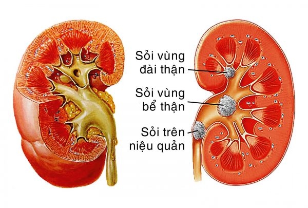 Những đối tượng dễ mắc sỏi đường tiết niệu