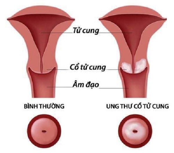 Hầu hết các trường hợp ung thư cổ tử cung là do nhiễm virus HPV.