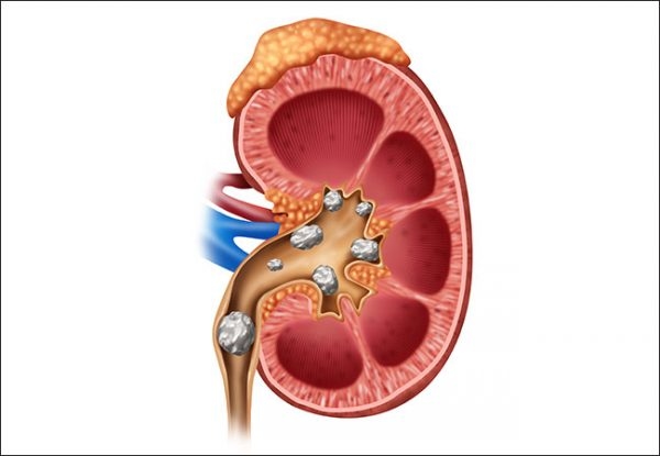 Những hiểu lẩm thường gặp về bệnh sỏi thận