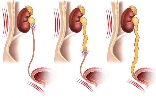 Nhưng nguy hiểm từ sỏi niệu quản