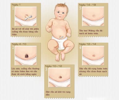 Thoát vị rốn ở trẻ em khi nào cần phẫu thuật?