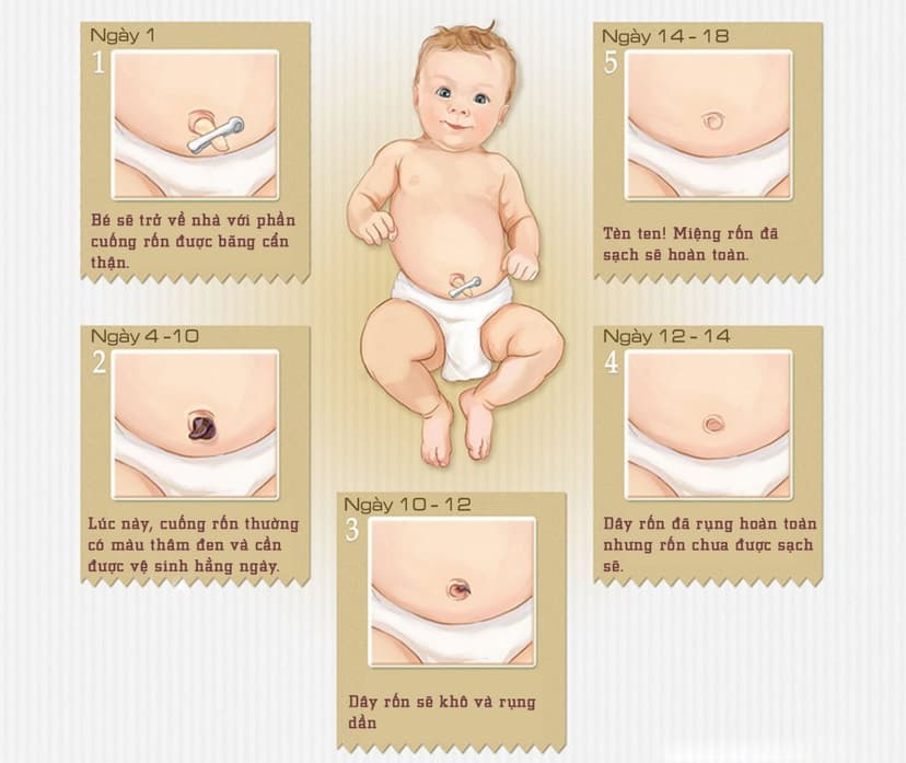 Thoát vị rốn ở trẻ em khi nào cần phẫu thuật?