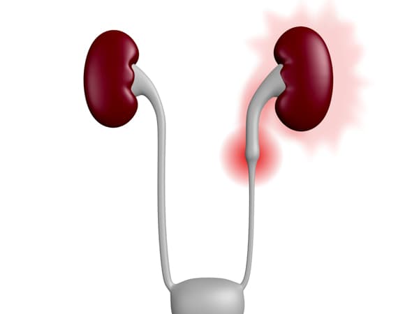3 Sai lầm khiến bệnh sỏi thận trở nên
