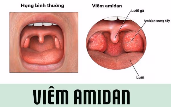 viêm amidan ở trẻ em