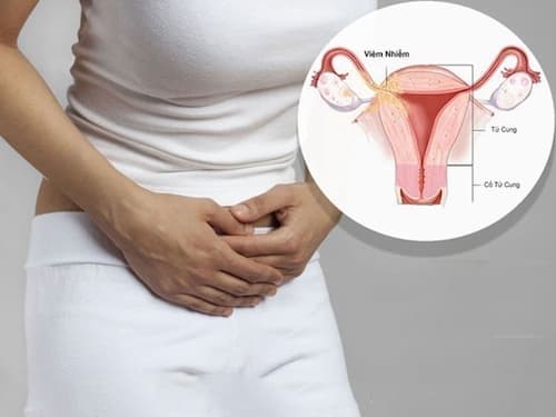 viêm phần phụ có nguy hiểm không