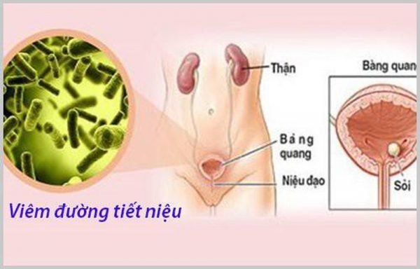 viêm đường tiết niệu có tự khỏi không