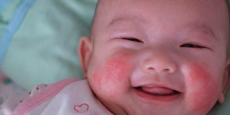 Các dạng c ở trẻ em và cách điều trị?