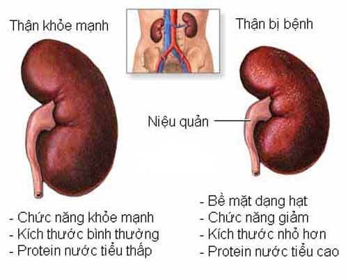 Nguy hiểm khi tự ý điều trị bệnh thận cho bé bằng thuốc nam