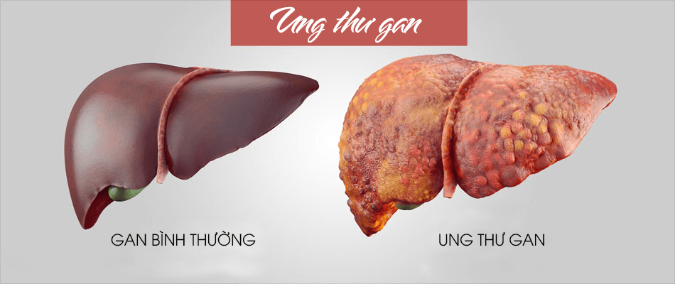 Hiện nay, ung thư gan là bệnh ung thư có tỉ lệ mắc mới cao nhất ở nước ta, đặc biệt tỷ lệ tử vong do căn bệnh này gần tương đương số người mắc bệnh. (ảnh minh hoạ)