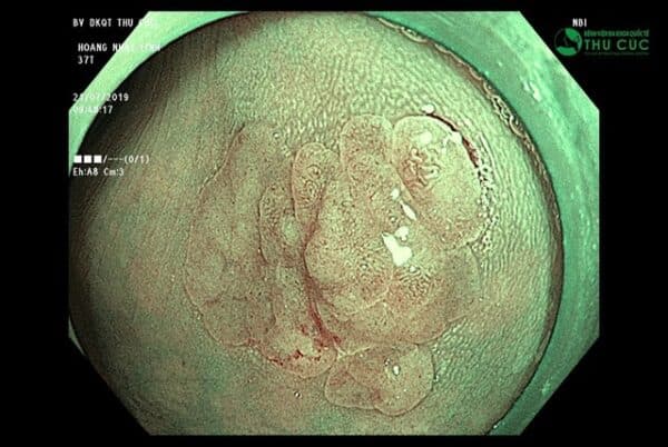 Không chỉ nhẹ nhàng, êm ái, công nghệ nội soi hiện đại còn có thể phát hiện sớm ung thư tiêu hóa từ sớm