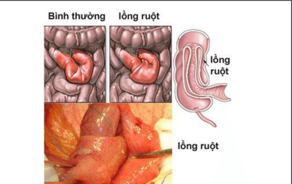 Hình ảnh minh hoạ lồng ruột bệnh tiêu hoá nguy hiểm ở trẻ em