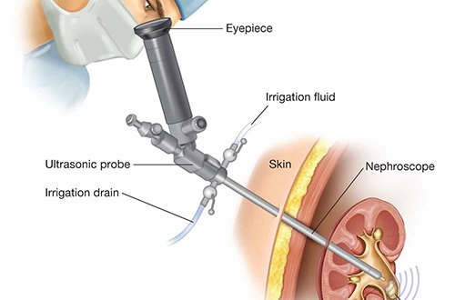 Tìm hiểu tán sỏi thận là gì sẽ giúp người bệnh có lựa chọn điều trị phù hợp nhất.