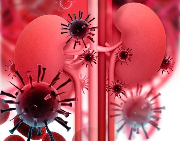 Viêm thận là biến chứng nguy hiểm nhất khi sỏi xuống bàng quang